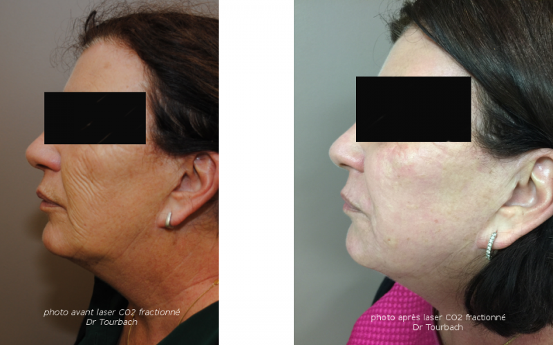 Traitement du visage par laser médical et peeling en Belgique Traitement du visage par laser médical et peeling en Belgique