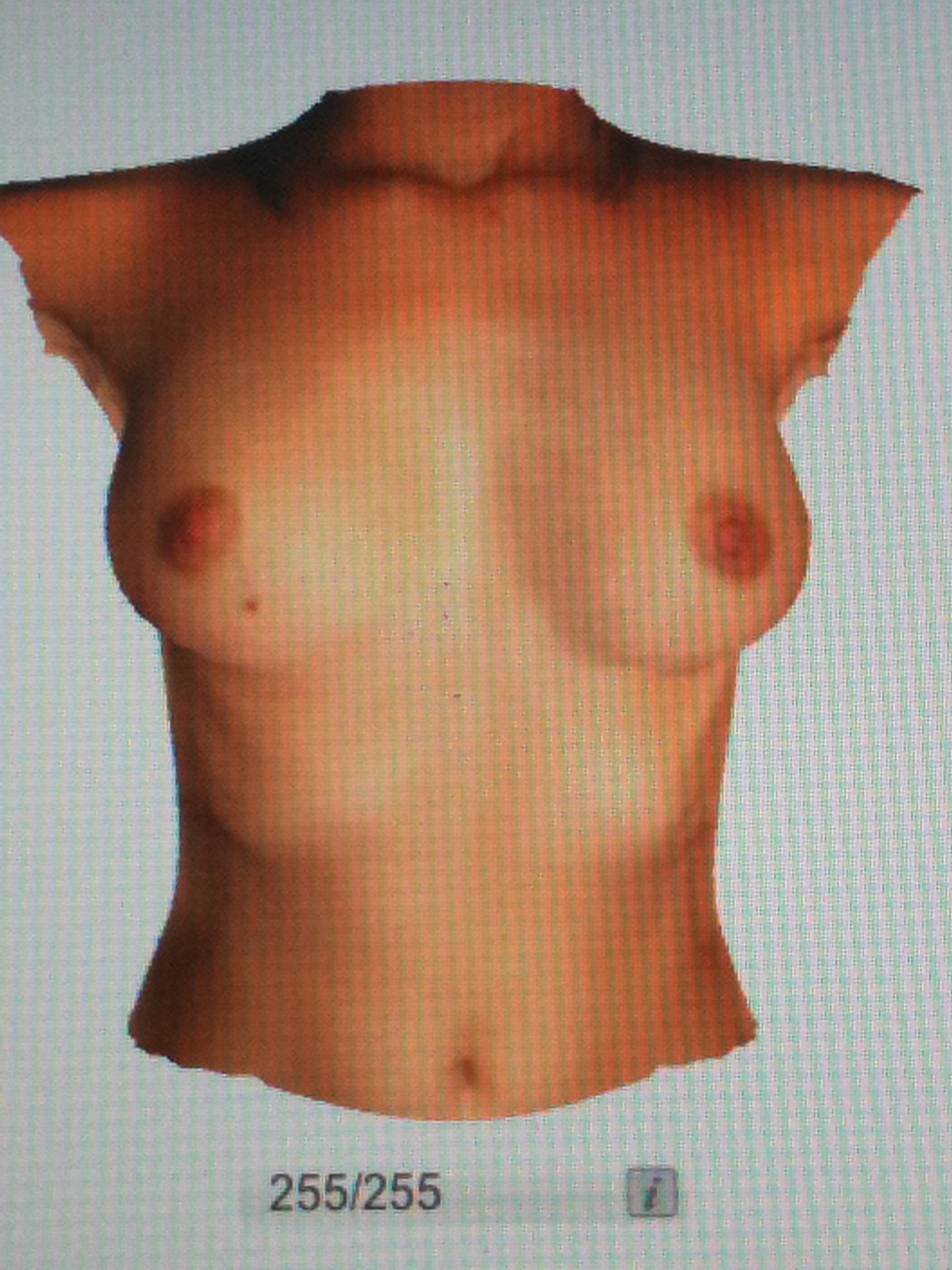 augmentation mammaire simutaion 3D