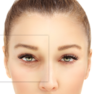 Bl&eacute;pharoplastie avant et apr&egrave;s des cernes 