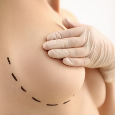 Le Docteur Tourbach vous explique pourquoi choisir des implants avec du liquide physiologique pour votre augmentation mammaire