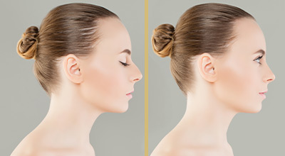 La rhinoplastique par ultrasons en clinique esthétique privée à Tournai