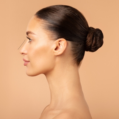 Femme ayant fait une rhinoplastie