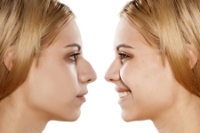 Rhinoplastie en Belgique : comment bien choisir son chirurgien ?