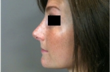 Nouvelles galeries de photos de Rhinoplastie