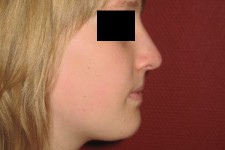 Rhinoplastie moderne: évolution des techniques de chirurgie esthétique du nez