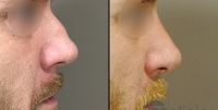 photo rhinoplastie homme avant après profil