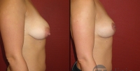 Photo pexie mammaire avant-après profil