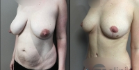 Réduction mammaire photos avant-après pat1