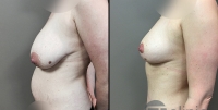 Réduction mammaire photos avant-après pat1